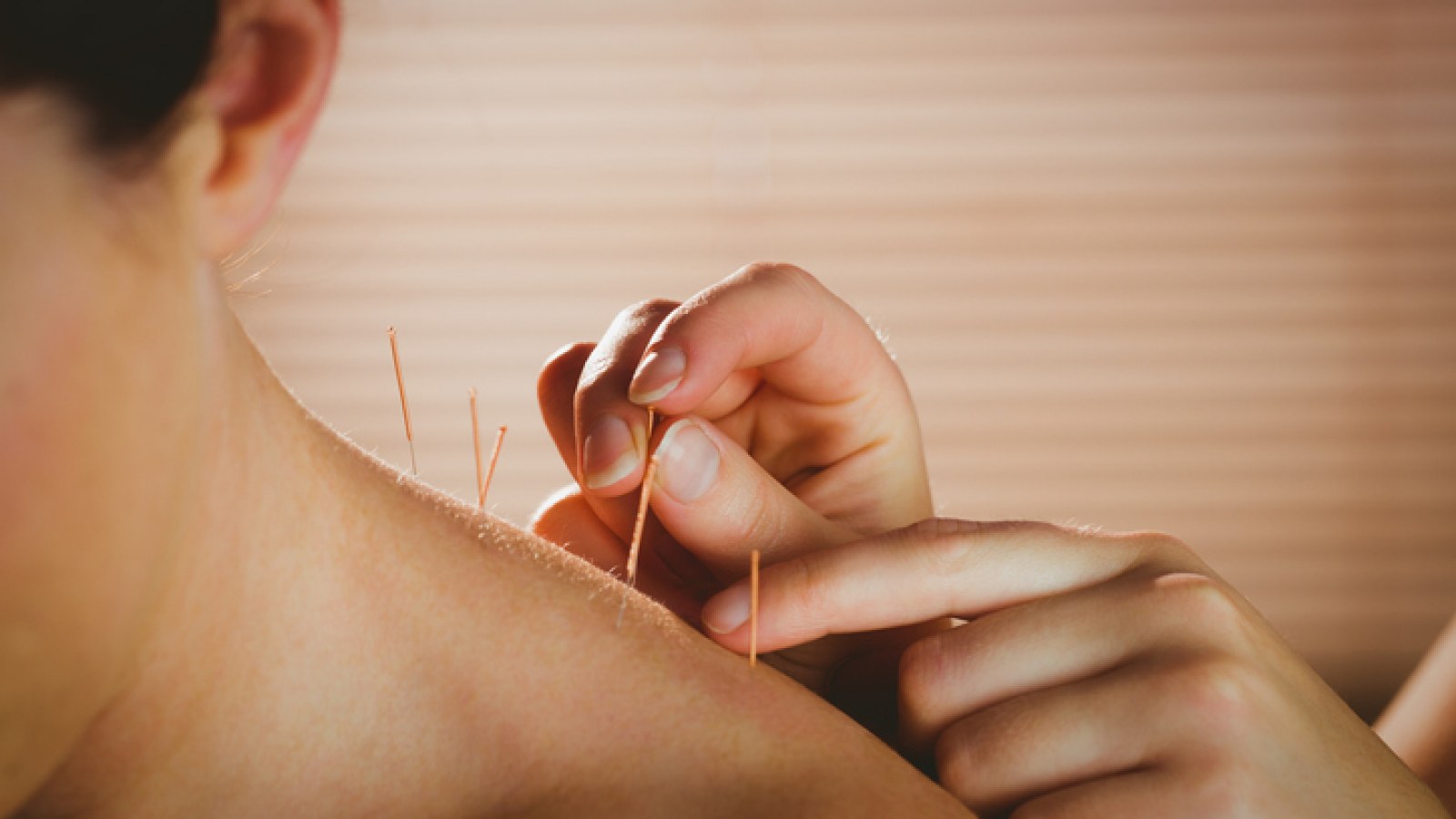 Acupuncture