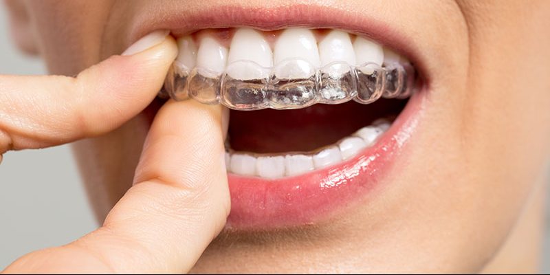 Invisible Braces, Is it For You Find Out Here