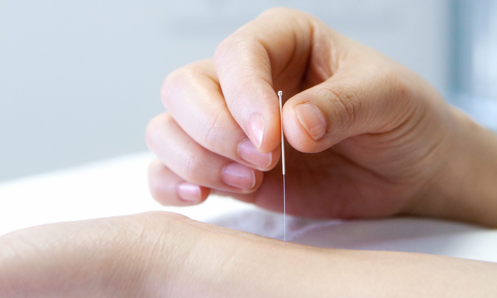 What to Expect During a Chinese Acupuncture Treatment