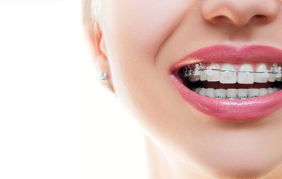 About Incognito Braces: Is It More Expensive?